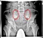 röntgenbild-thomas-dahmen-Becken-AP-markiert