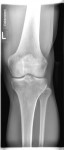 röntgenbild-thomas-dahmen-Knie L AP