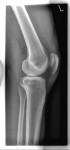 röntgenbild-thomas-dahmen-Knie L LAT